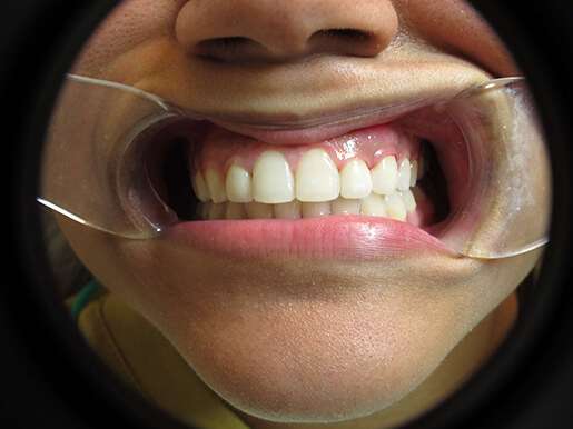 Bergen Premiere Dentistry – Before & After