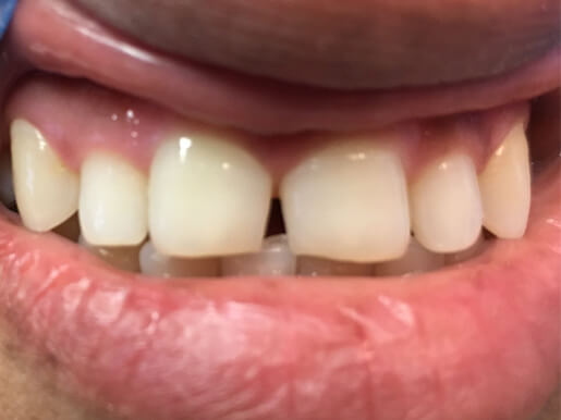 Bergen Premiere Dentistry – Before & After
