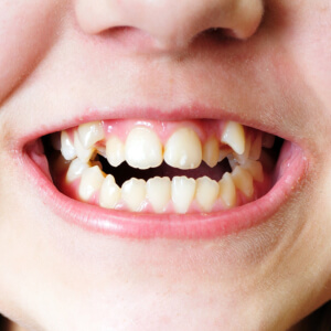 Bergen Premiere Dentistry – Impacted Teeth