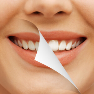 Bergen Premiere Dentistry – Teeth Whitening