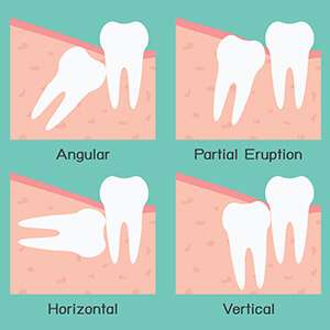 Bergen Premiere Dentistry – Impacted Teeth