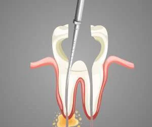Root Canal Treatment & Therapy in NJ: Myths vs. Facts